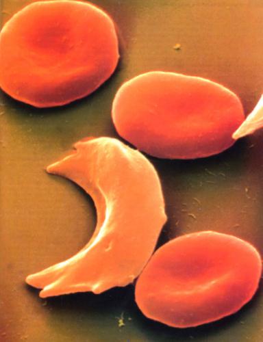 Sickle cell anemia is a disease that warps red blood cells into a sickle 